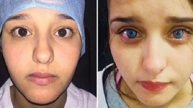 Casablanca : Une marocaine change la couleur de ses yeux !
